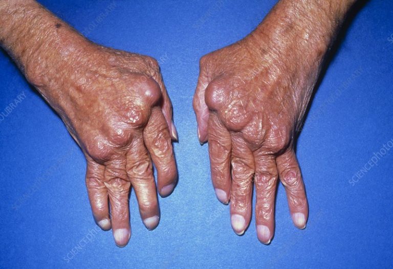 Rheumatoid Arthritis of the Hand and Wrist